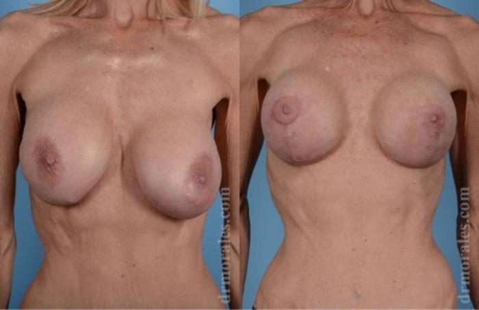 Before & After Breast Revision Case 626 View 1 View in Houston, TX