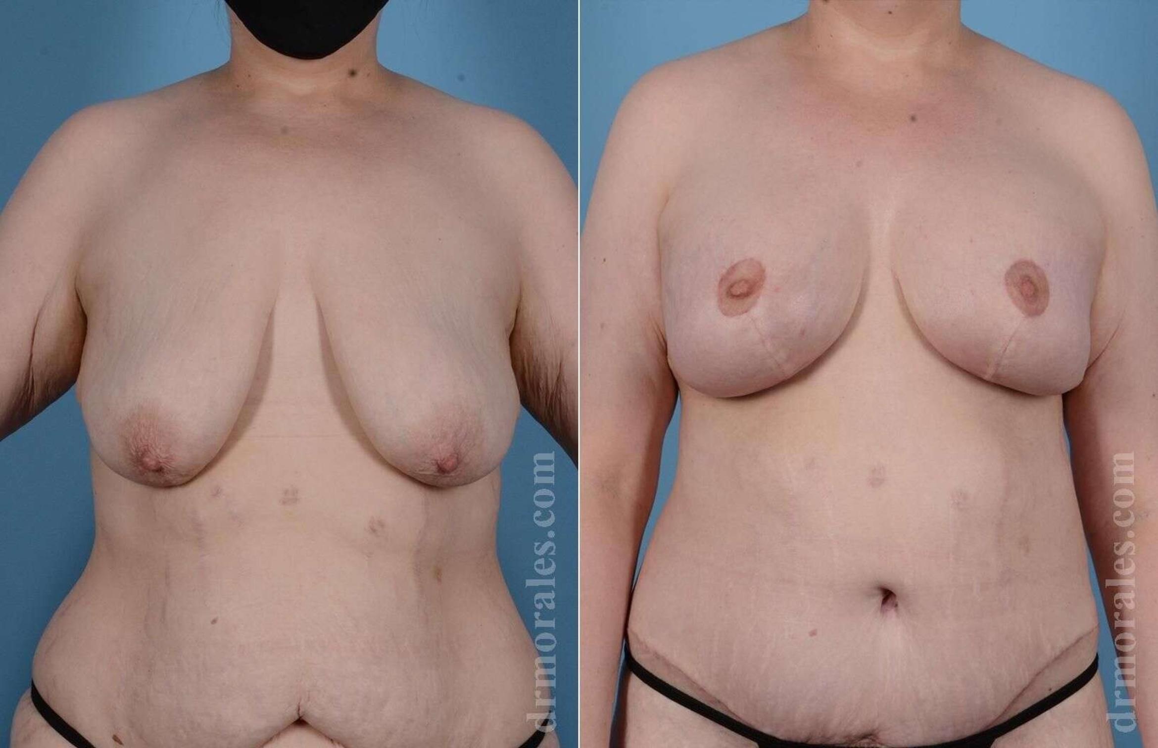 Before & After Breast Revision Case 79 View 1 View in Houston, TX