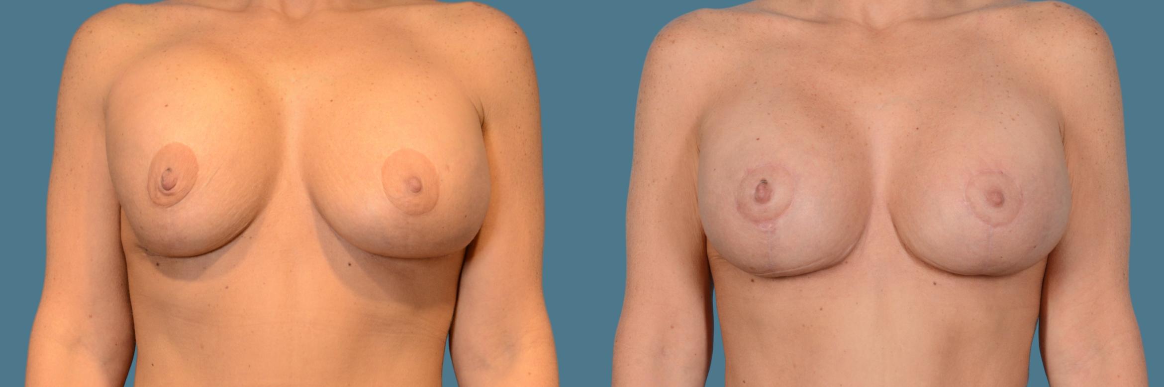 Before & After Breast Revision Case 836 Front View in Houston, TX