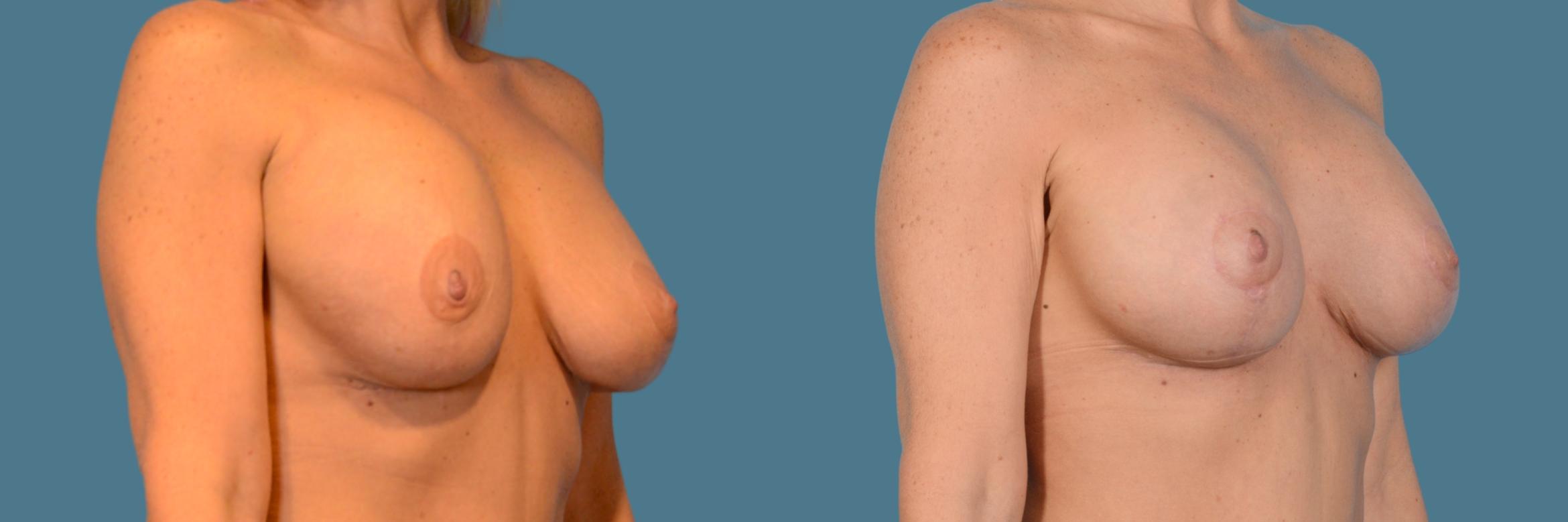 breast revision with dr. morales, board certified plastic surgeon in houston, tx