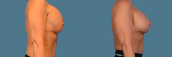 Before & After Breast Revision Case 836 Right Side View in Houston, TX