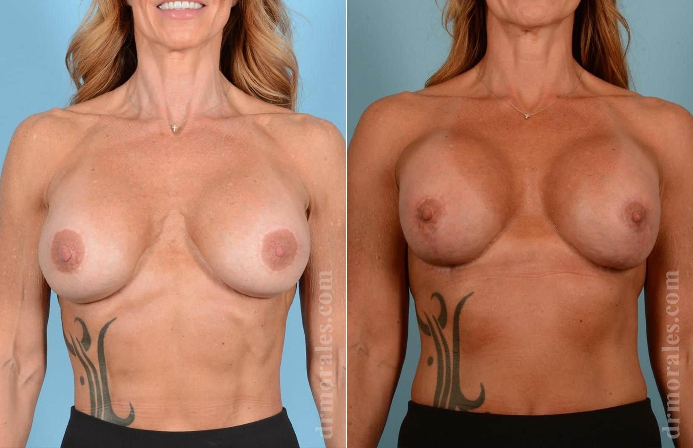 Before & After Breast Revision Case 85 View 1 View in Houston, TX