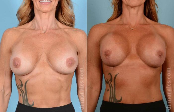 Before & After Breast Revision Case 85 View 1 View in Houston, TX