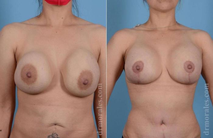 Before & After Breast Revision Case 87 View 1 View in Houston, TX