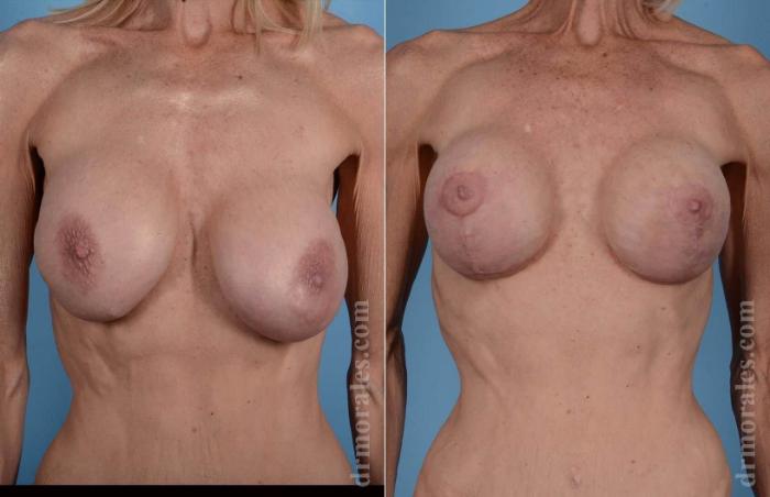 Before & After Breast Revision Case 89 View 1 View in Houston, TX