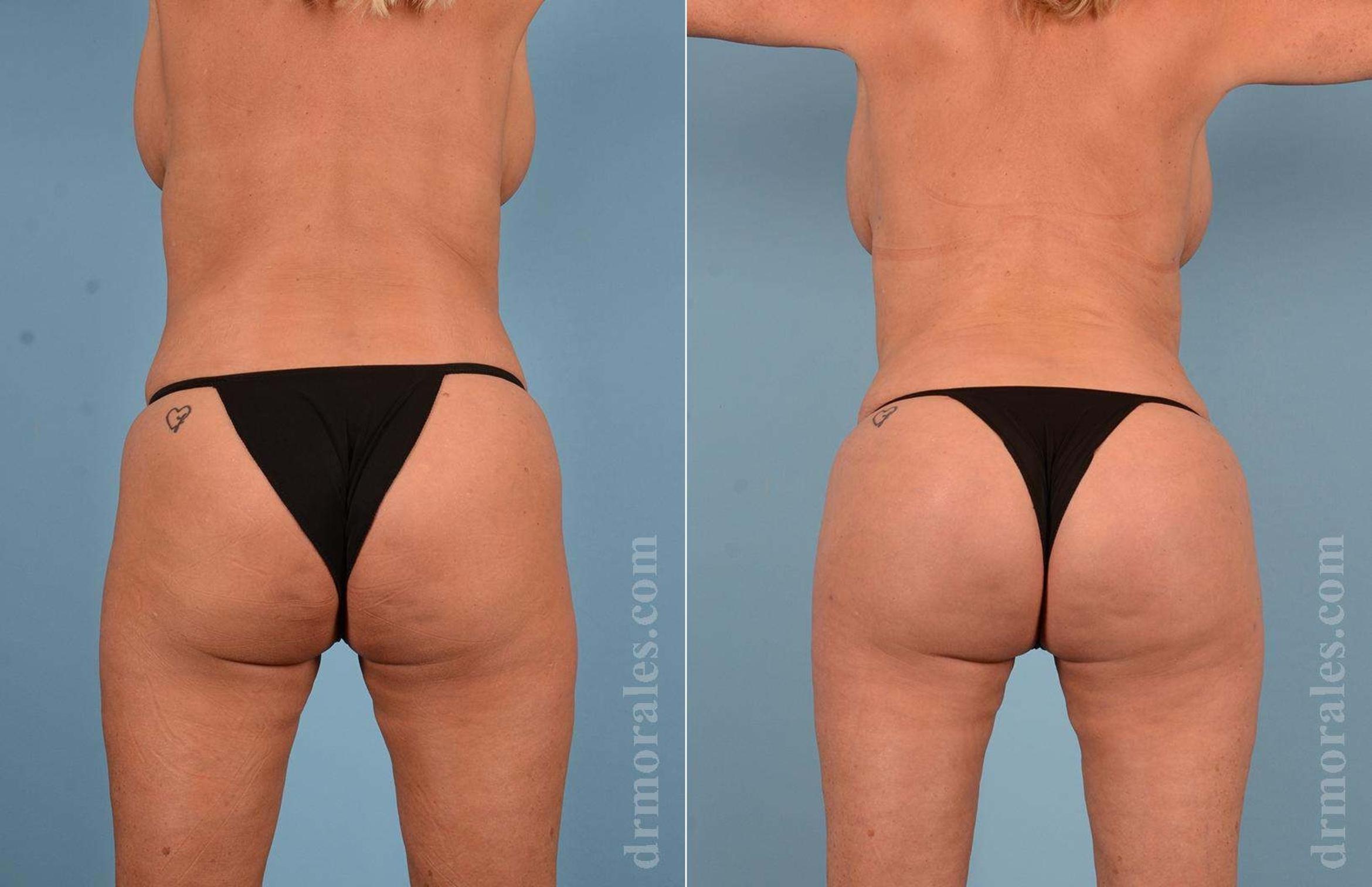 Before & After Butt Augmentation With Implants Case 15 View 1 View in Houston, TX
