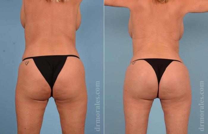 Before & After Butt Augmentation With Implants Case 15 View 1 View in Houston, TX