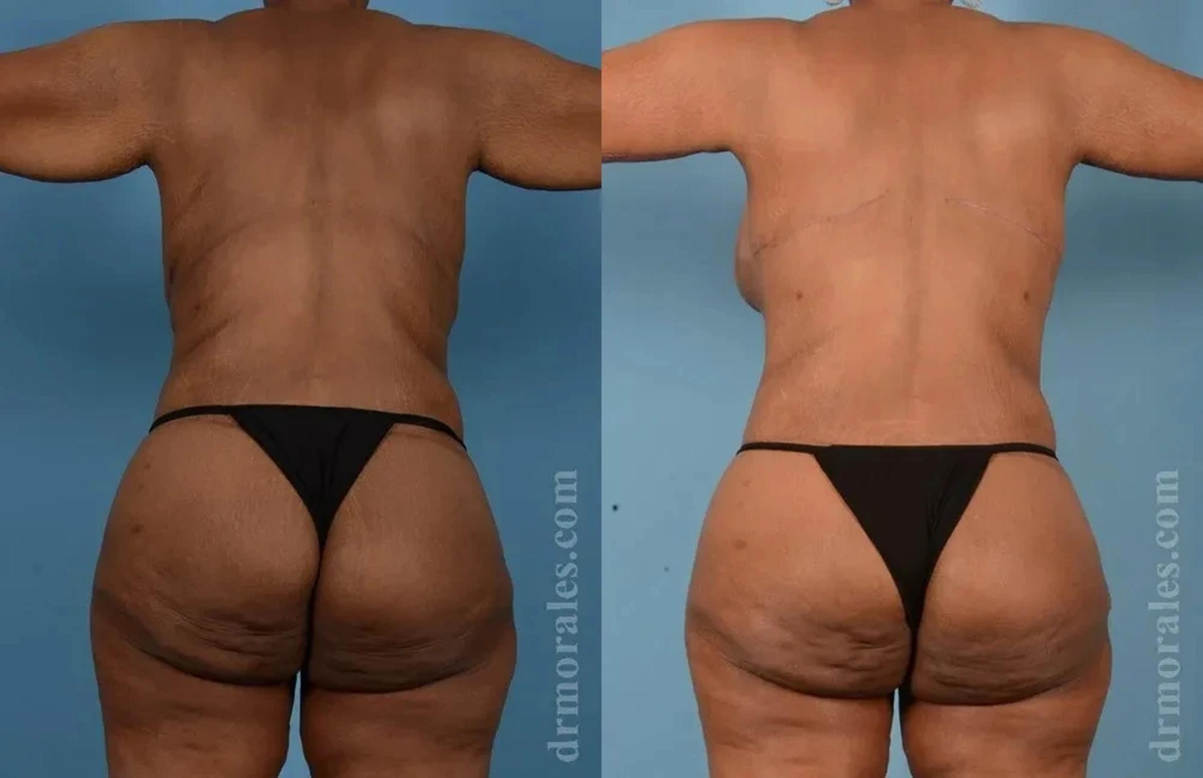 Before & After Butt Augmentation With Implants Case 229 View 1 View in Houston, TX