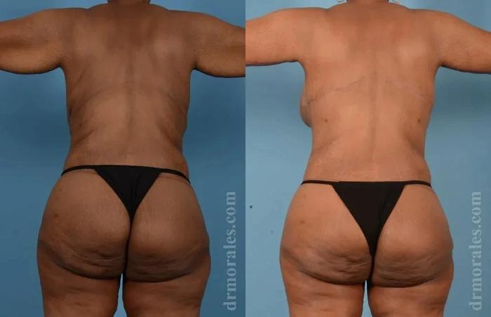 Before & After Butt Augmentation With Implants Case 229 View 1 View in Houston, TX
