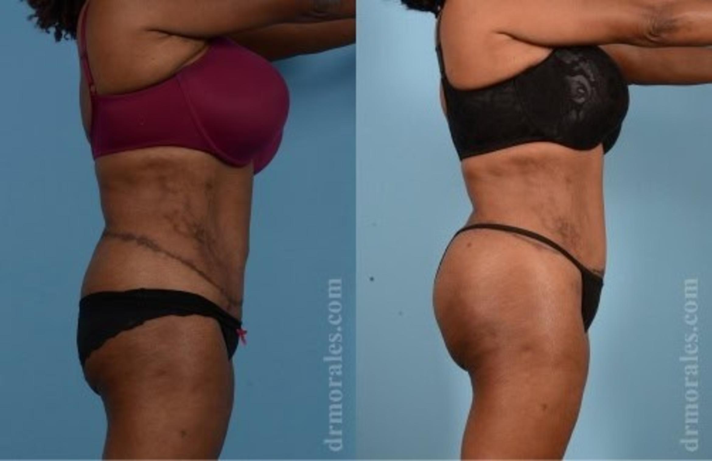 Before & After Butt Augmentation With Implants Case 312 View 1 View in Houston, TX