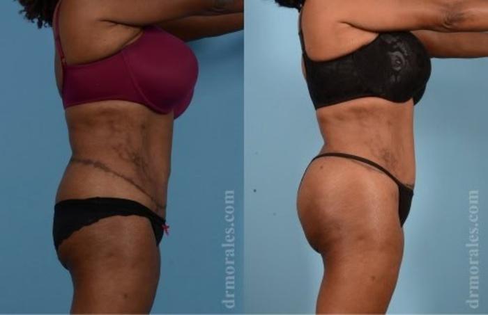 Before & After Butt Augmentation With Implants Case 312 View 1 View in Houston, TX