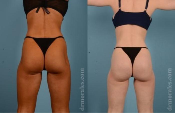Before & After Butt Augmentation With Implants Case 314 View 1 View in Houston, TX