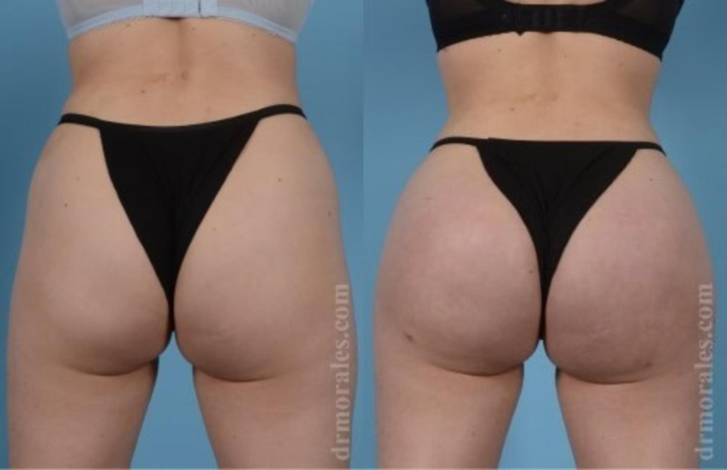Before & After Butt Augmentation With Implants Case 320 View 1 View in Houston, TX