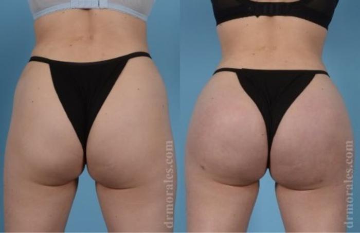 Before & After Butt Augmentation With Implants Case 320 View 1 View in Houston, TX