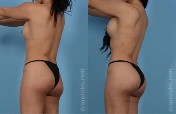 Before & After Butt Augmentation With Implants Case 332 View 1 View in Houston, TX