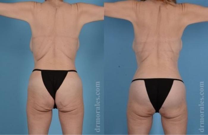 Before & After Butt Augmentation With Implants Case 335 View 1 View in Houston, TX