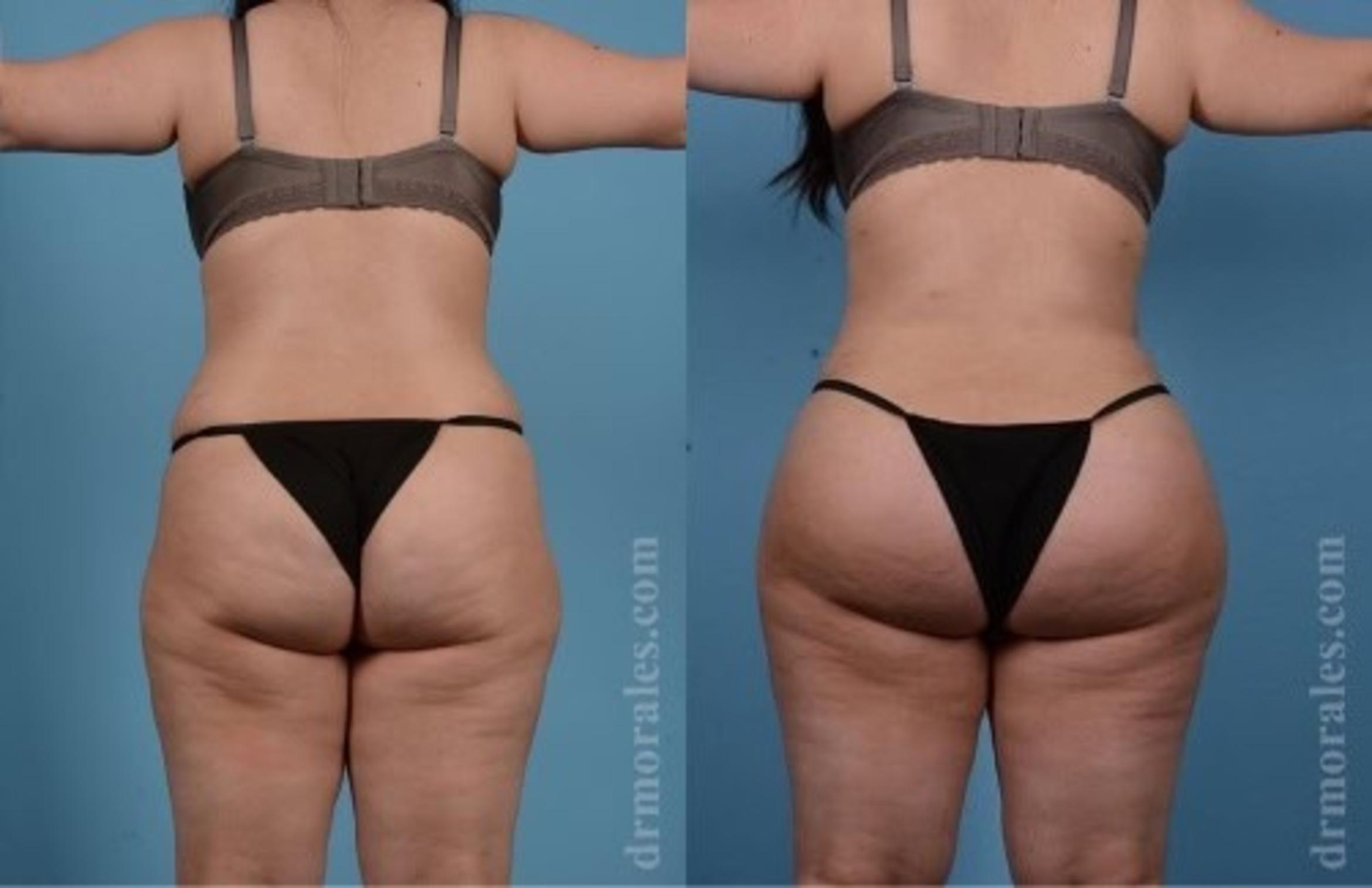 Before & After Butt Augmentation With Implants Case 336 View 1 View in Houston, TX