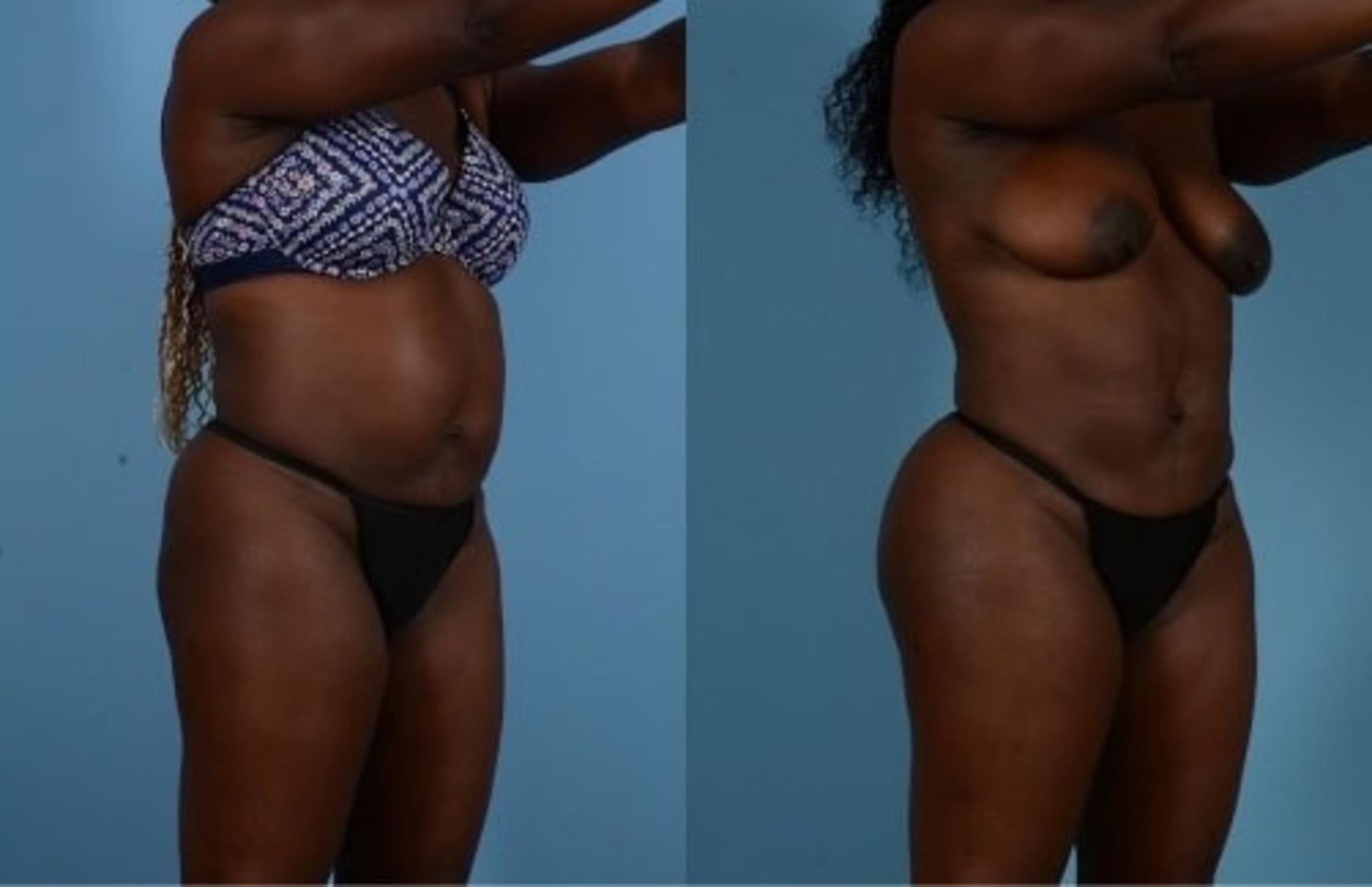 Before & After Butt Augmentation With Implants Case 337 View 1 View in Houston, TX