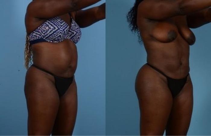 Before & After Butt Augmentation With Implants Case 337 View 1 View in Houston, TX