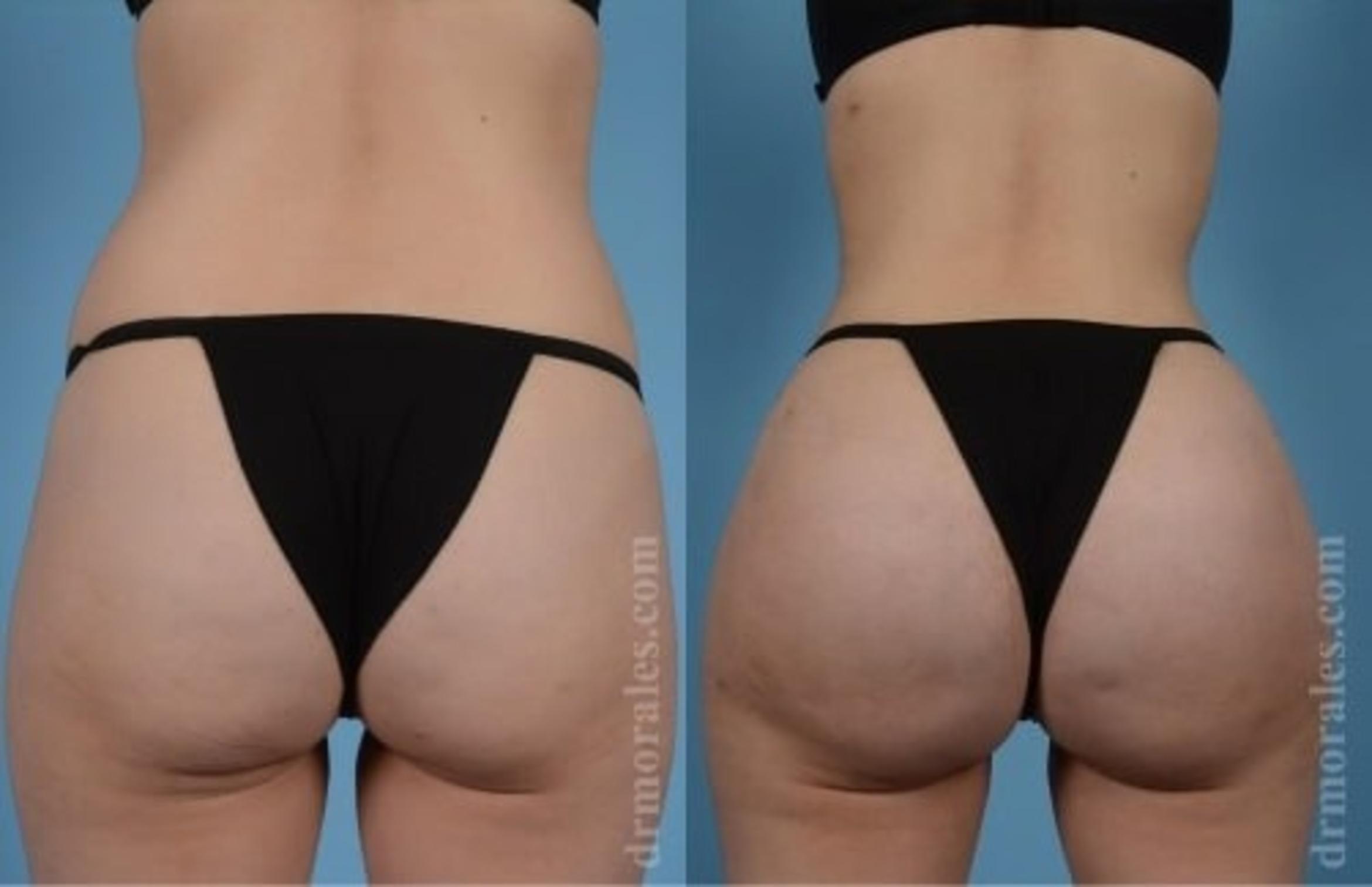Before & After Butt Augmentation With Implants Case 338 View 1 View in Houston, TX