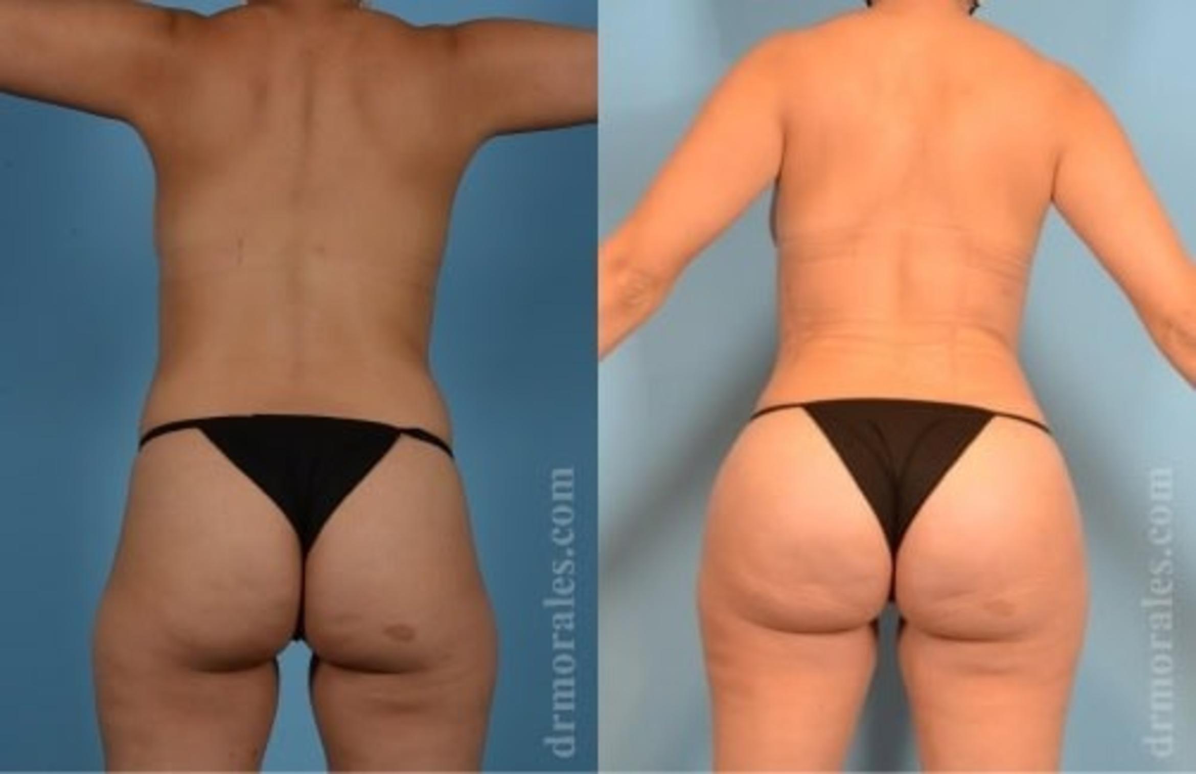 Before & After Butt Augmentation With Implants Case 342 View 1 View in Houston, TX