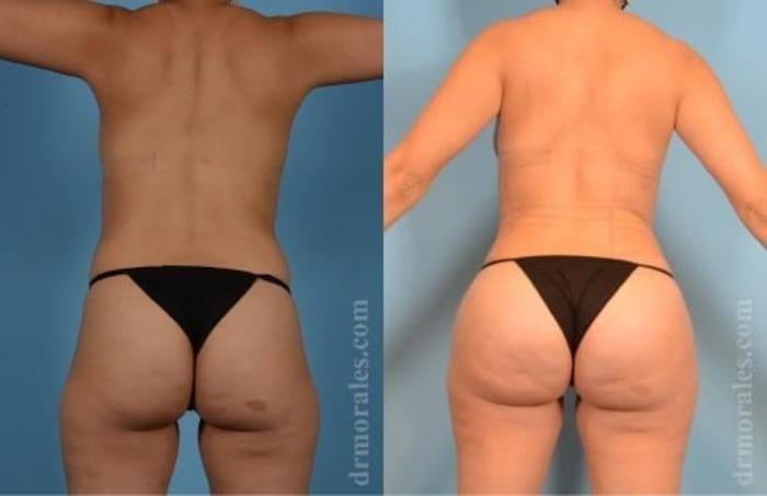 Before & After Butt Augmentation With Implants Case 342 View 1 View in Houston, TX