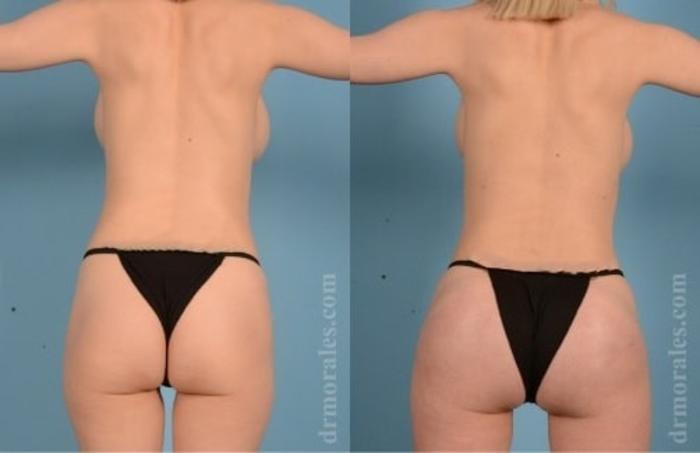 Before & After Butt Augmentation With Implants Case 344 View 1 View in Houston, TX