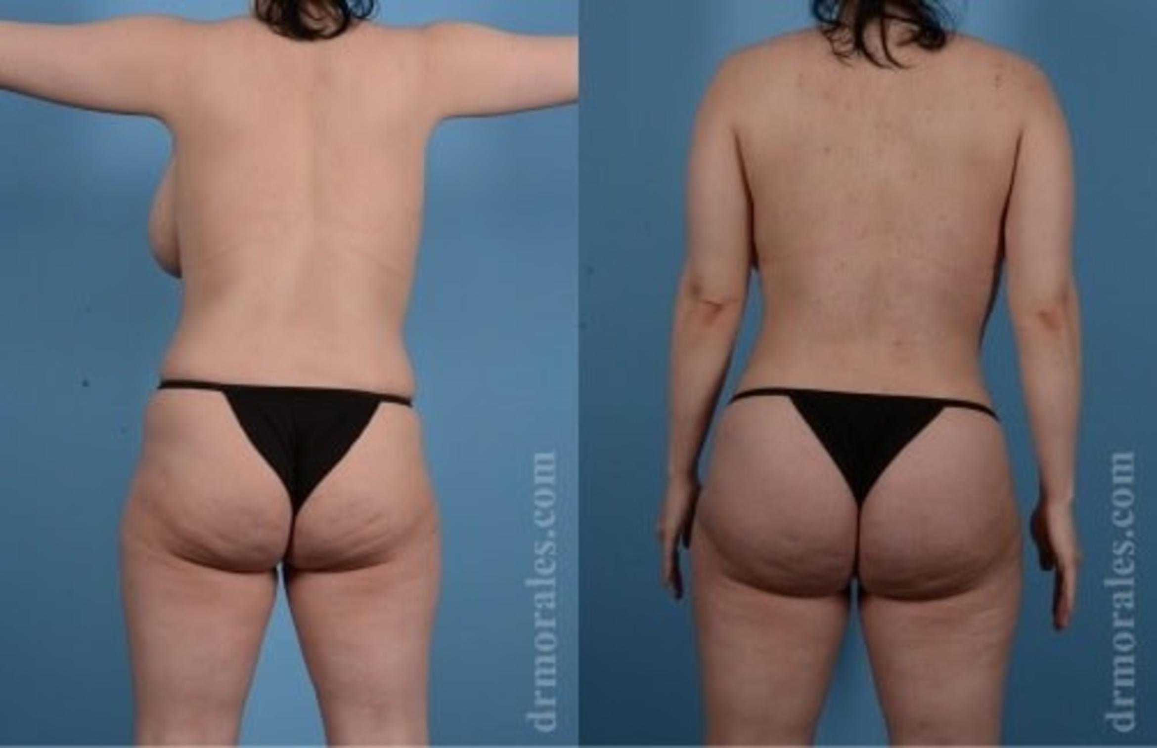 Before & After Butt Augmentation With Implants Case 345 View 1 View in Houston, TX