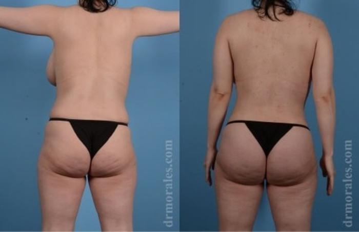 Before & After Butt Augmentation With Implants Case 345 View 1 View in Houston, TX