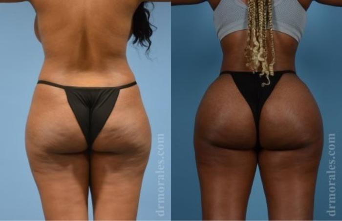 Before & After Butt Augmentation With Implants Case 346 View 1 View in Houston, TX