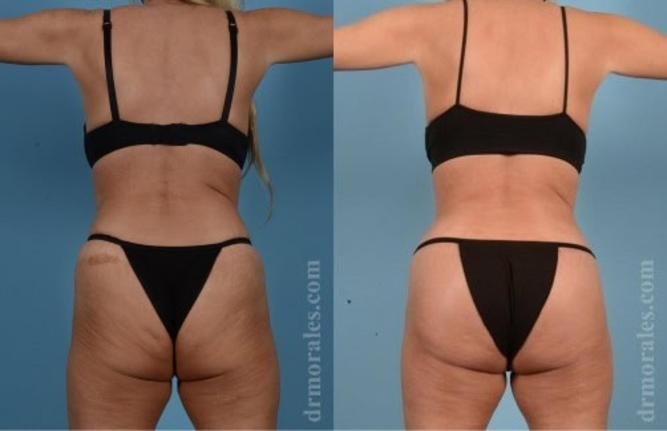 Before & After Butt Augmentation With Implants Case 347 View 1 View in Houston, TX