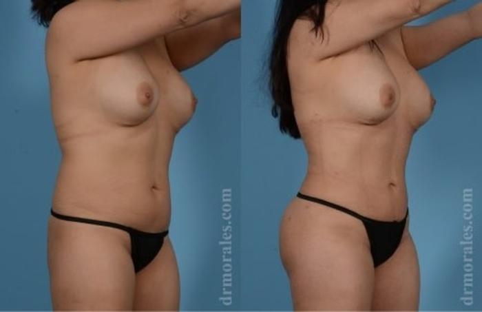 Before & After Butt Augmentation With Implants Case 349 View 1 View in Houston, TX