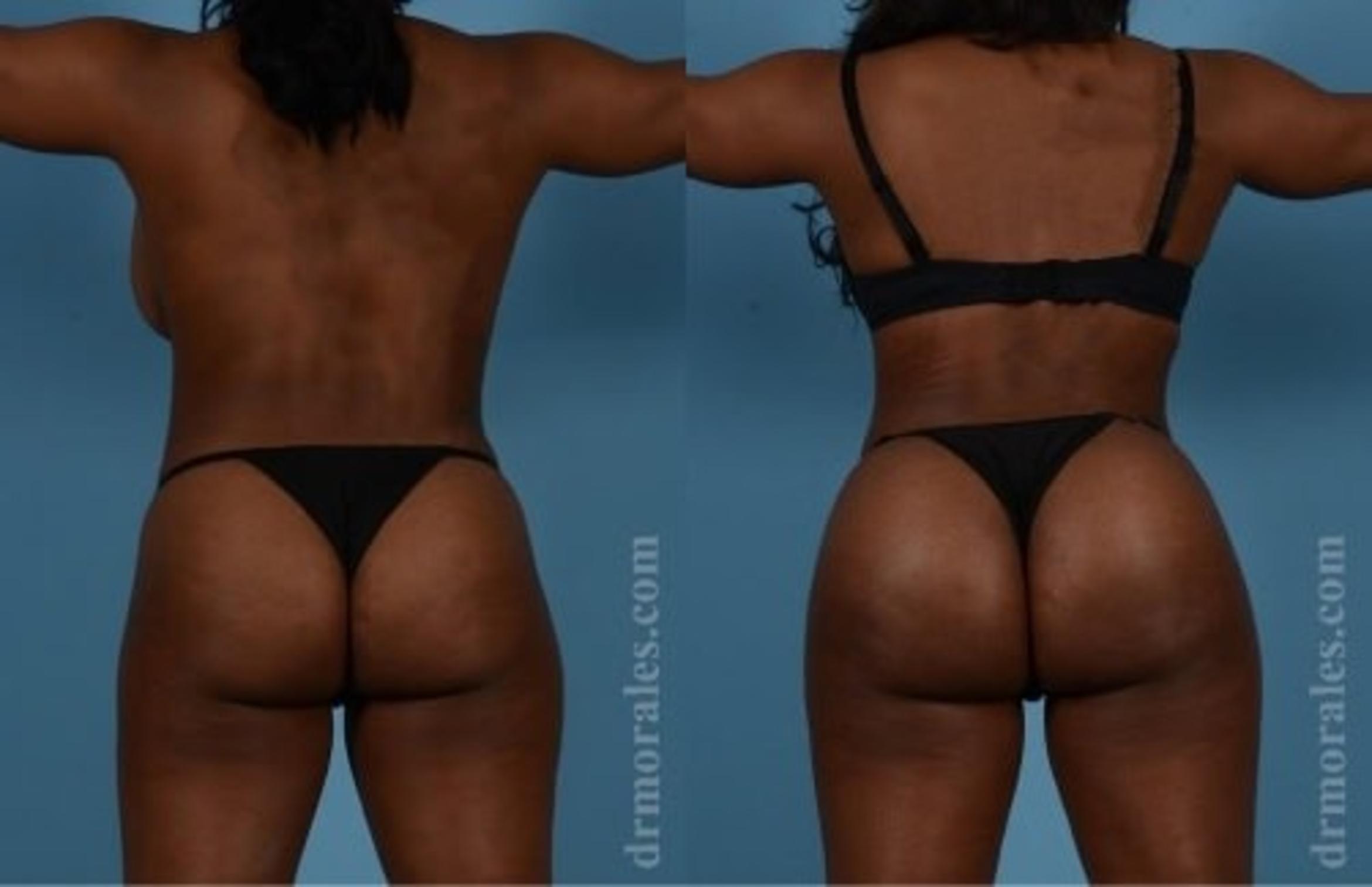 Before & After Butt Augmentation With Implants Case 350 View 1 View in Houston, TX