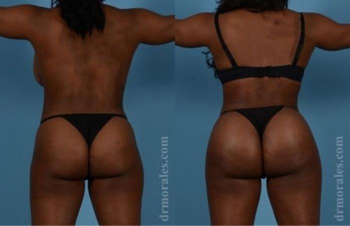 Before & After Butt Augmentation With Implants Case 350 View 1 View in Houston, TX