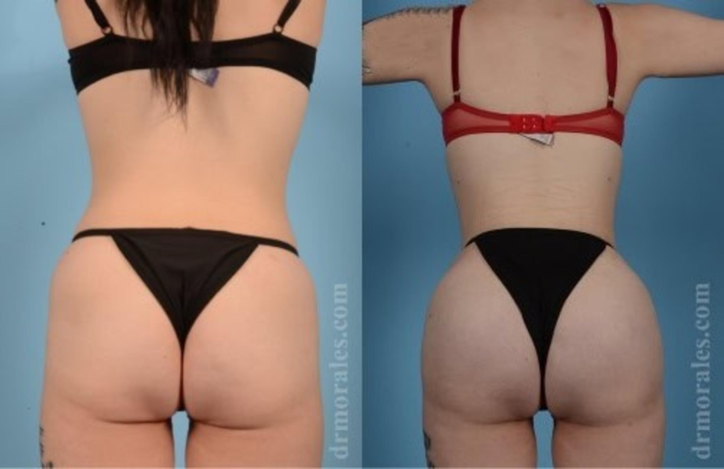 Before & After Butt Augmentation With Implants Case 351 View 1 View in Houston, TX