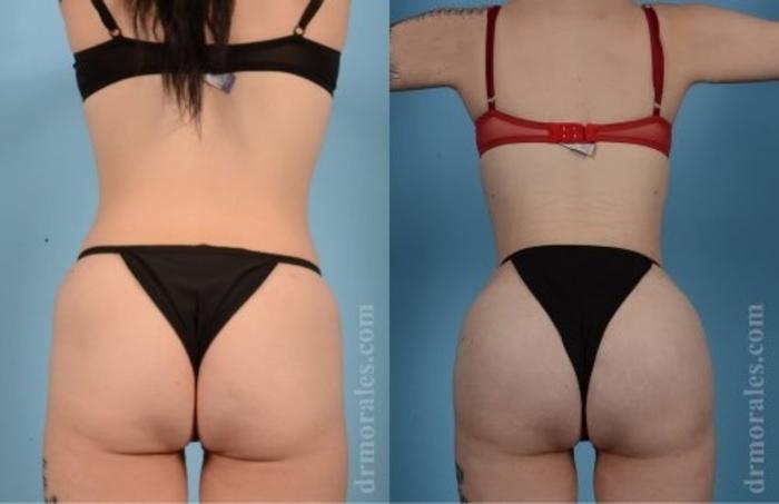 Before & After Butt Augmentation With Implants Case 351 View 1 View in Houston, TX