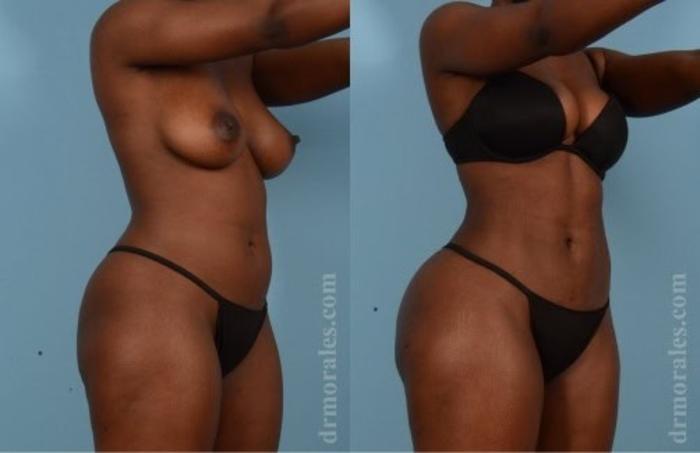 Before & After Butt Augmentation With Implants Case 353 View 1 View in Houston, TX