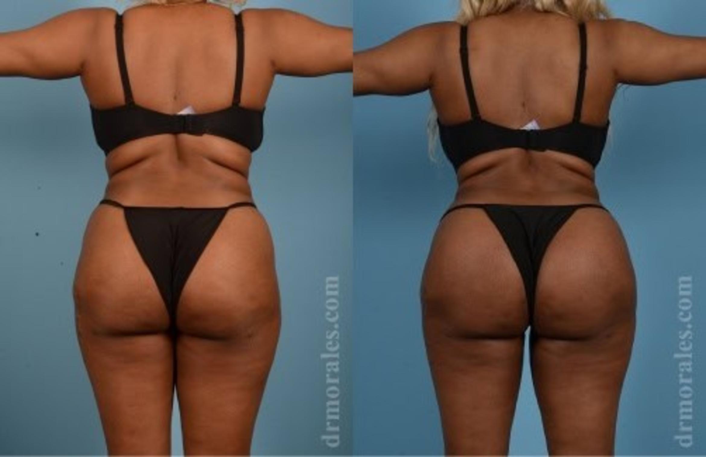 Before & After Butt Augmentation With Implants Case 354 View 1 View in Houston, TX