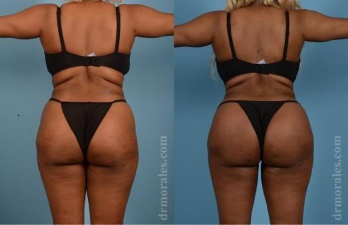 Before & After Butt Augmentation With Implants Case 354 View 1 View in Houston, TX