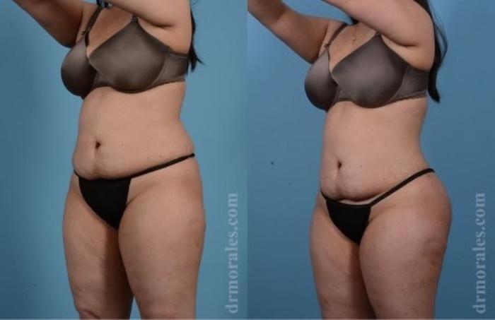 Before & After Butt Augmentation With Implants Case 355 View 1 View in Houston, TX