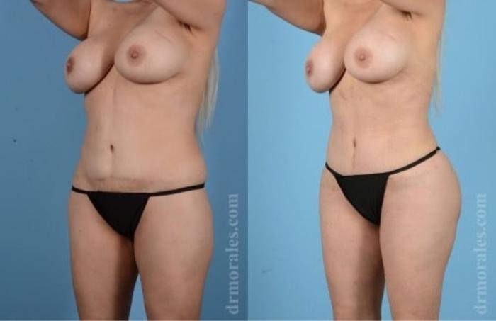 Before & After Butt Augmentation With Implants Case 356 View 1 View in Houston, TX