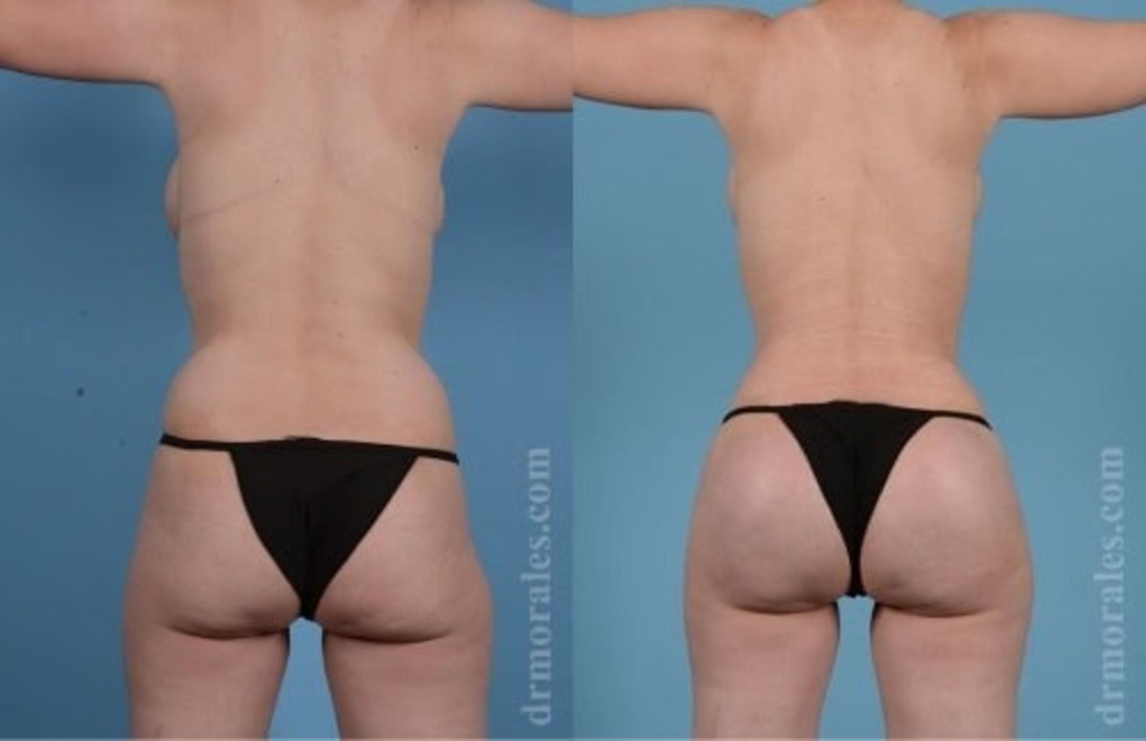 Before & After Butt Augmentation With Implants Case 357 View 1 View in Houston, TX