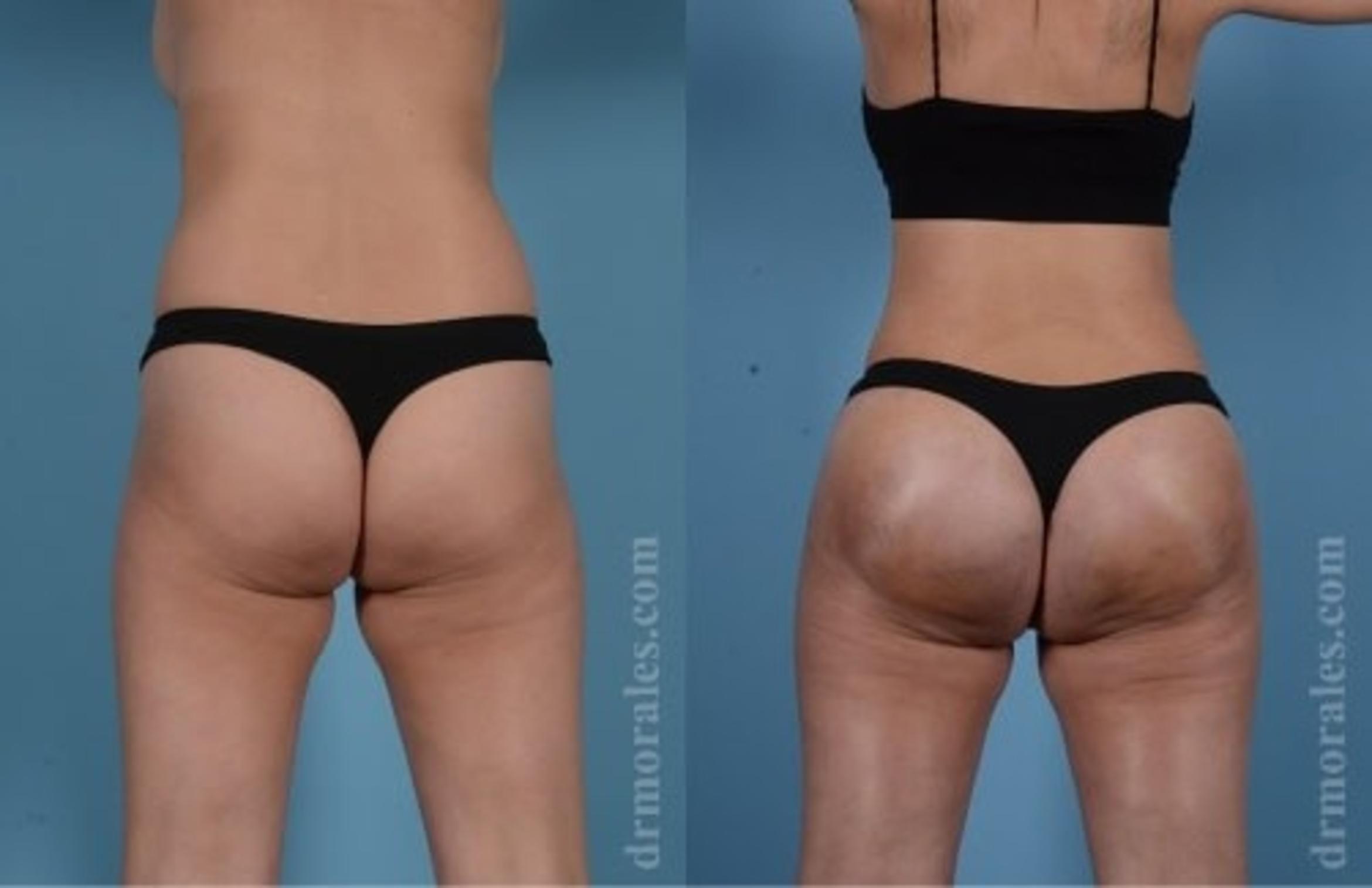 Before & After Butt Augmentation With Implants Case 359 View 1 View in Houston, TX