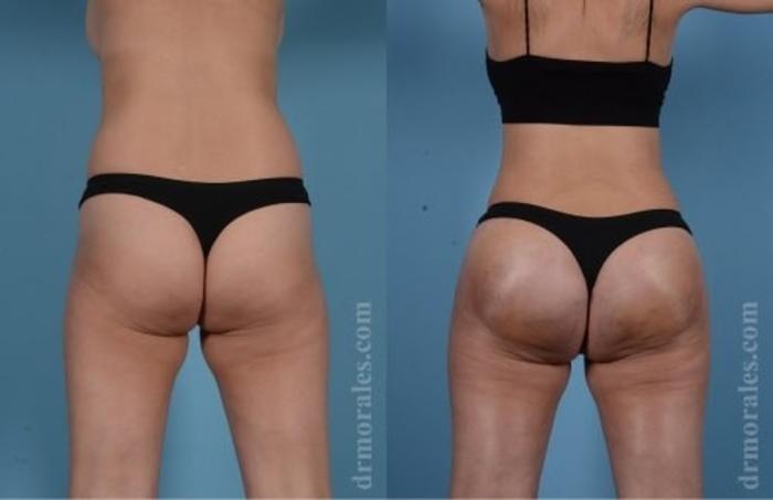 Before & After Butt Augmentation With Implants Case 359 View 1 View in Houston, TX