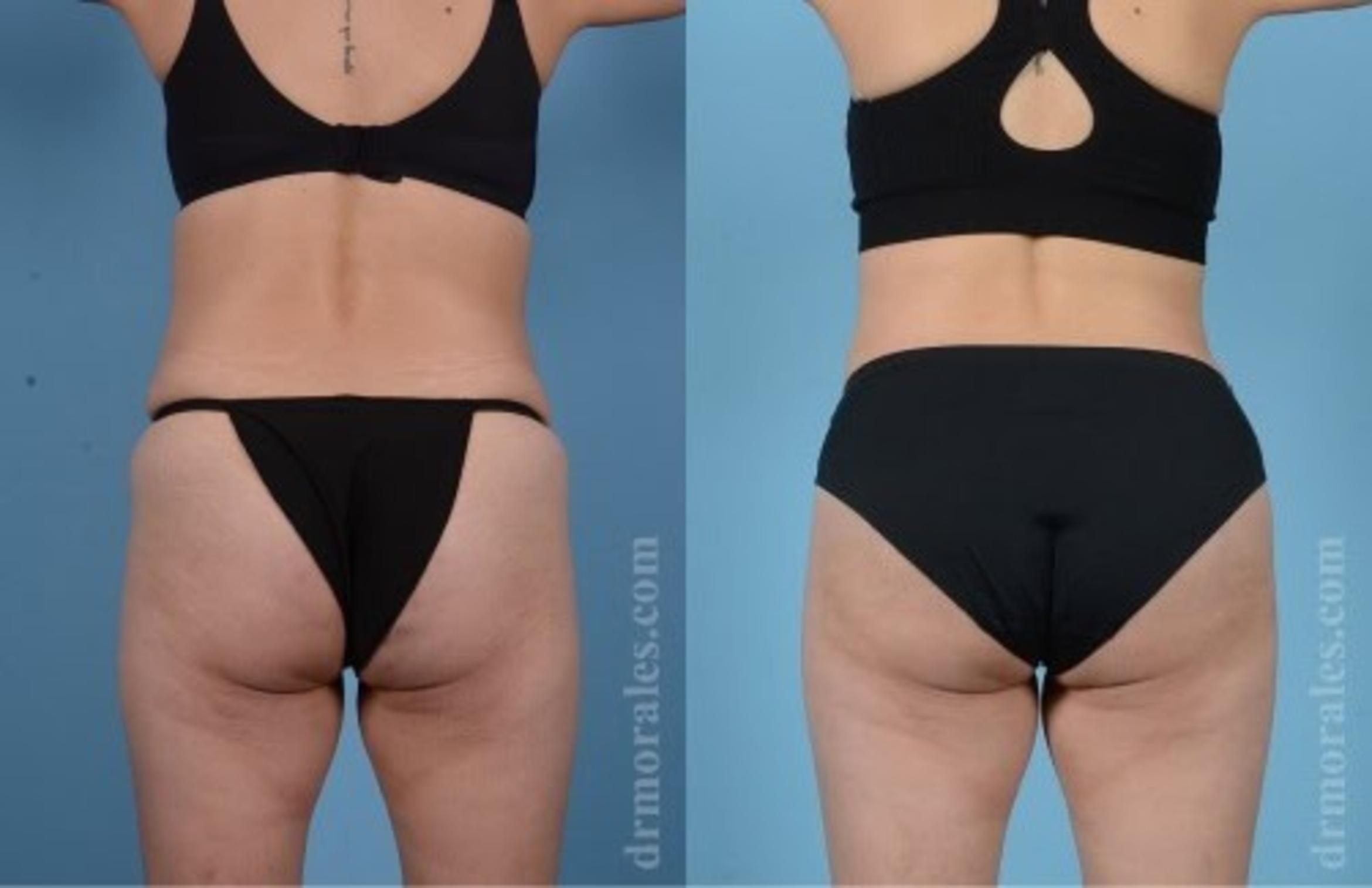 Before & After Butt Augmentation With Implants Case 360 View 1 View in Houston, TX
