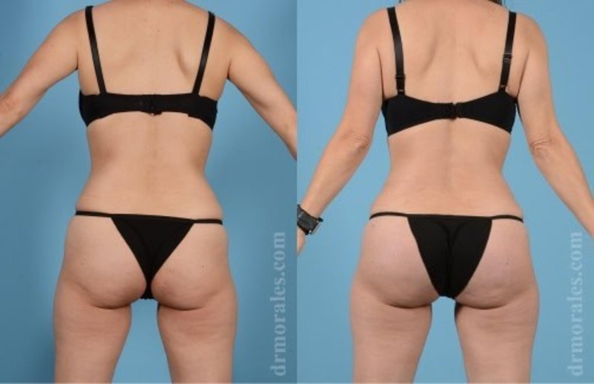 Before & After Butt Augmentation With Implants Case 361 View 1 View in Houston, TX