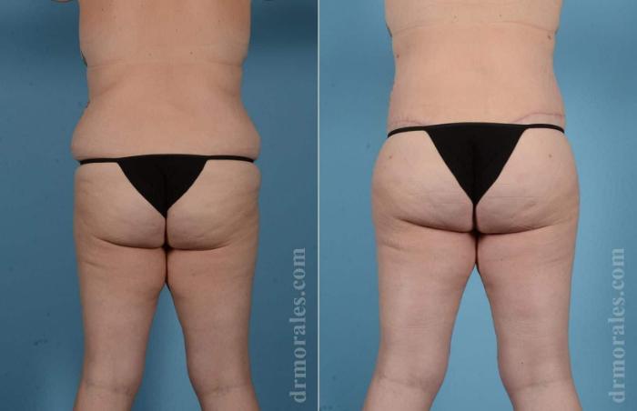 Before & After Butt Augmentation With Implants Case 80 View 1 View in Houston, TX