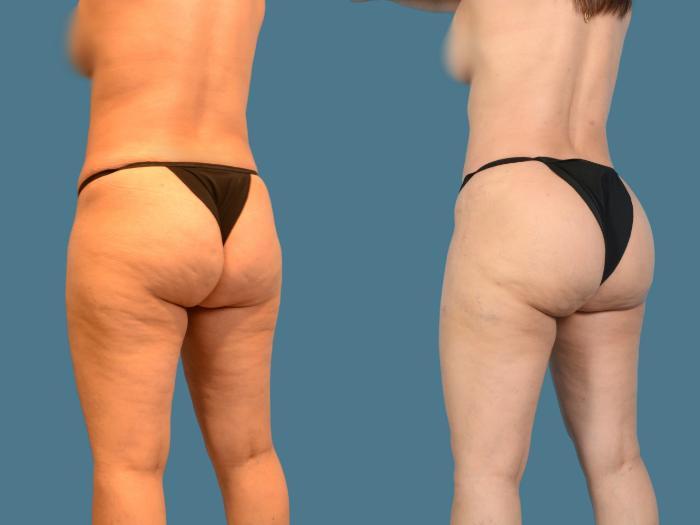 Before & After Butt Augmentation With Implants Case 834 Left Oblique View in Houston, TX