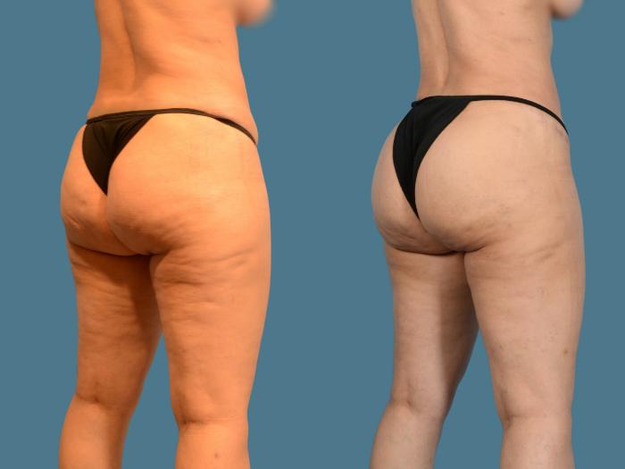 Before & After Butt Augmentation With Implants Case 834 Right Oblique View in Houston, TX