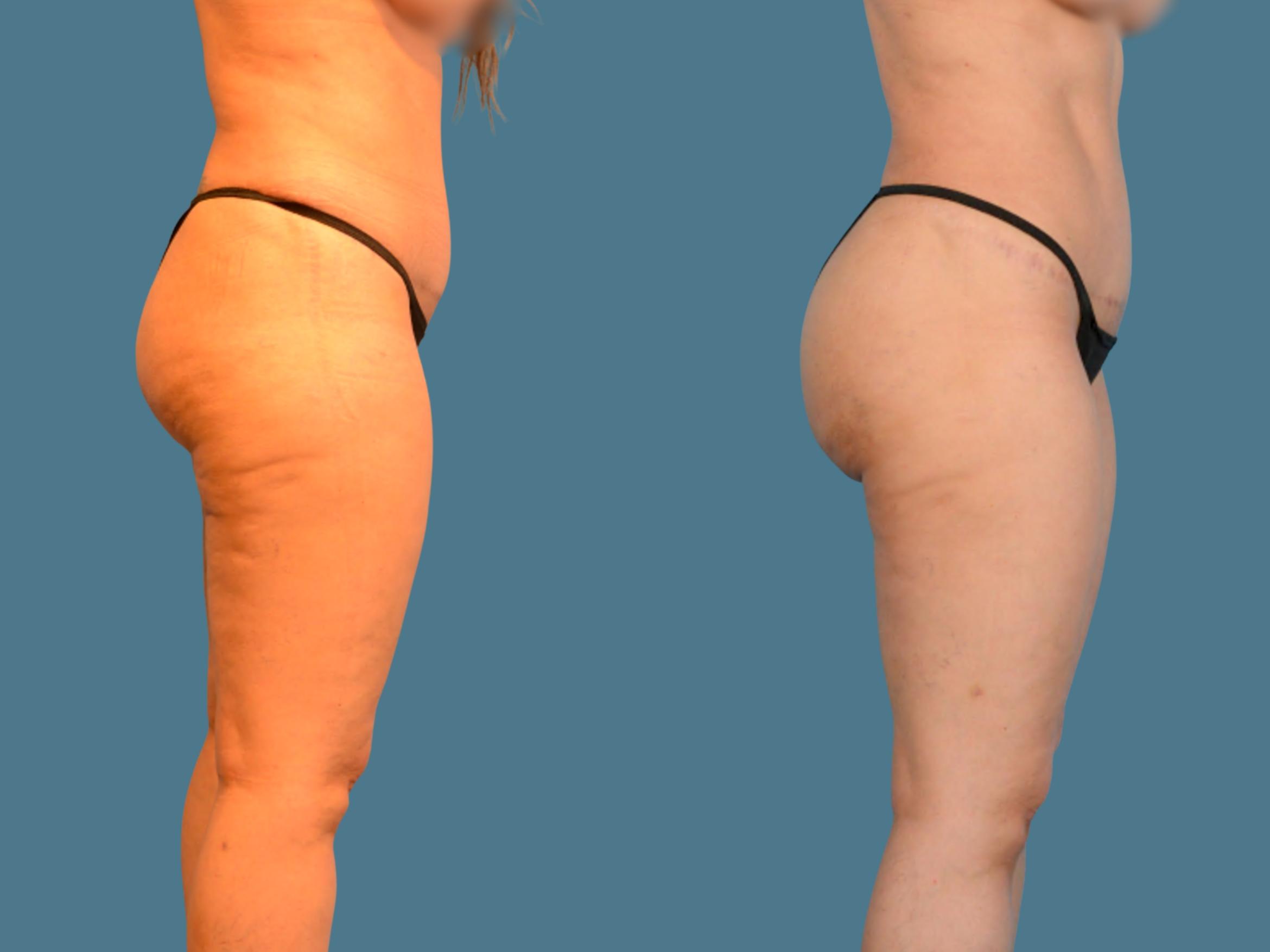 Before & After Butt Augmentation With Implants Case 834 Right Side View in Houston, TX